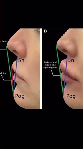 Proper #lip #technique #lips #filler