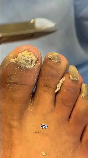 That's the thing. When you're using big nip, they're called nail nippers. #footcare