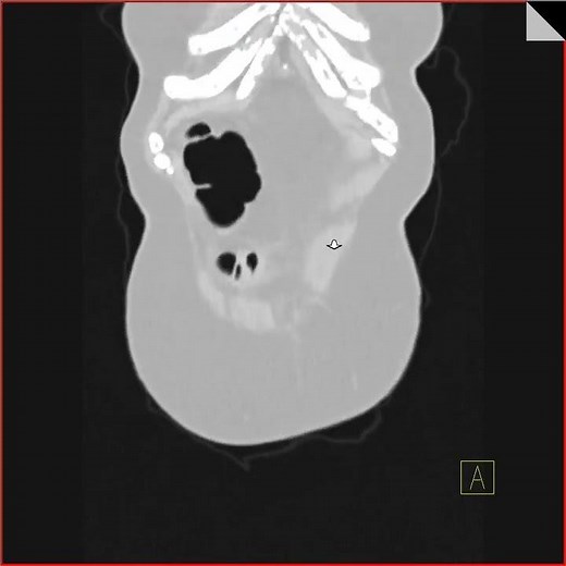 Virtual colonoscopy with cancer in transverse colon
