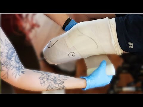 Transtibial Amputee: Limb Assessment and Cast