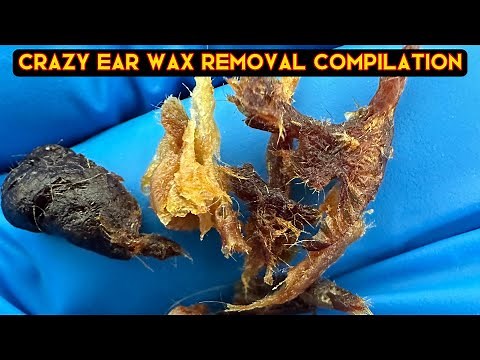 Unbelievable Ear Wax Removal Compilation - August 2023 - Extremely Satisfying #earwaxremoval #asmr
