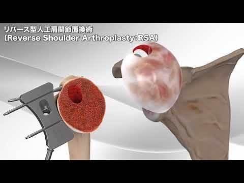 リバース型人工肩関節置換術（肩関節の手術）