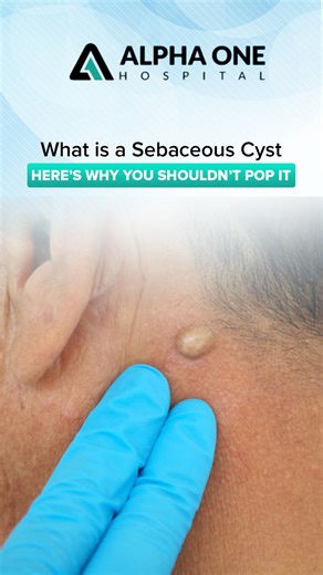 Alpha One Multispecialty Hospital on Instagram: "What is a Sebaceous Cyst? Here’s Why You Shouldn’t Pop It Yourself! A sebaceous cyst is a small, round, usually painless bump formed when the skin’s oil gland gets blocked. It may grow slowly and stay harmless for months, but if infected, it can become red, swollen, and painful. Dr. Khilchand Bhangale, General & Laparoscopic Surgeon at Alpha One Hospital, Navi Mumbai, explains that squeezing or popping a cyst at home is dangerous. It can worsen th