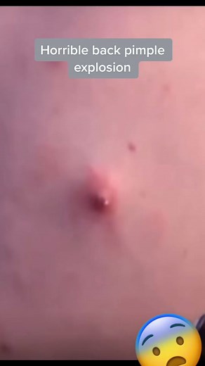 Amazing back pimple pop. #pimpleexplosion #zitpopper #blackheadremovals #whiteheadpimples #cystpopping #cystexplosion #acneremoval #skincare #largepimple #dilatedpore #dilatedporeofwiner