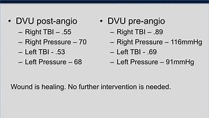 Wound Healing in PAD and Flexor Tenotomy