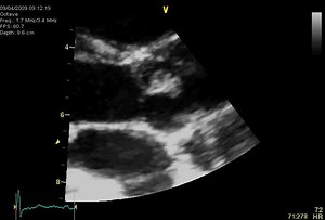 File:Asymptomatic-papillary-fibroelastoma-of-the-Aortic-valve-in-a-young-woman---a-case-report-1476-7120-7-43-S1.ogv - Wikimedia Commons