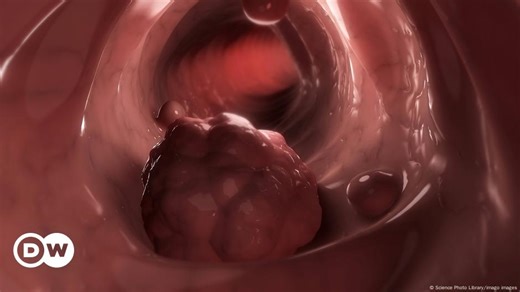 Bowel cancer rates rising in young people