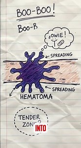 Vein Puncture Explained #NeedleInjury #VeinPuncture #MedicalBruise