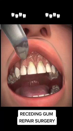 Understanding Receding Gum Repair Surgery: A Comprehensive Guide