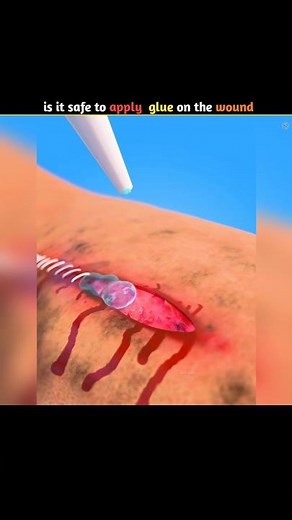 is It safe to apply super glue on the wound #facts #h2facts #shorts