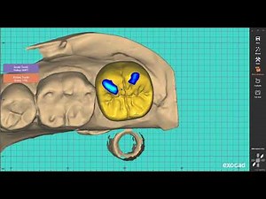 Exocad design guide: Singele Crown Design
