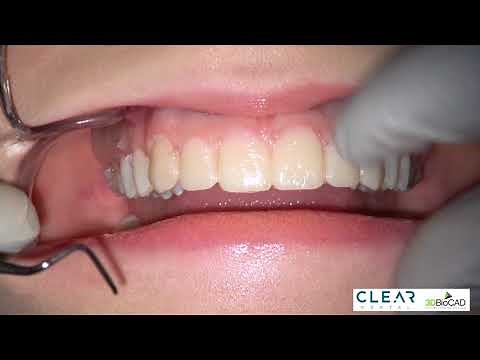 Mock-up Part 4 - Procedure