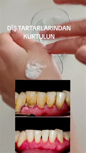 Diş tartarlarından kurtulun.