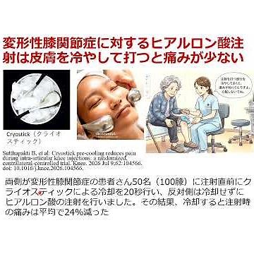 変形性膝関節症に対するヒアルロン酸注射は皮膚を冷やして打つと痛みが少ない。#御堂筋線 #戸田クリニック #大阪府吹田市豊津町14番1号
