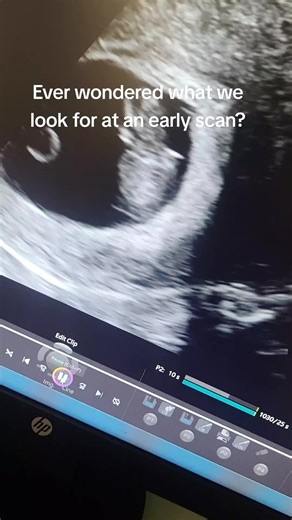 WindowToTheWomb Ellesmere Port on TikTok