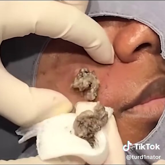 A deceivingly cheeky cyst ✌️❤️💥 #drpimplepopper #popaholics #oddlysatisfying #spot #pimple #zit #blackhead #cyst