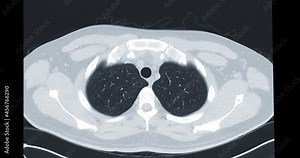 CT Chest or CT Lung axial mip view for diagnostic lung diseases and covid-19.