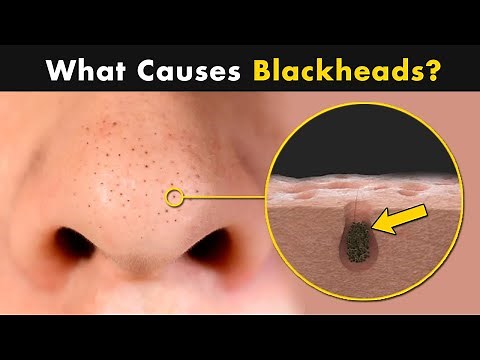 What Causes Blackheads on Our Skin? | Symptoms, Causes And Treatment