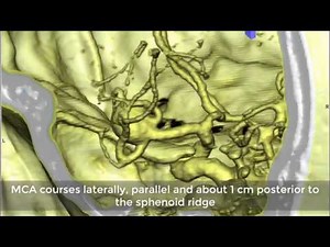 Left MCA Bifurcation Aneurysm: Stent assisted coiling