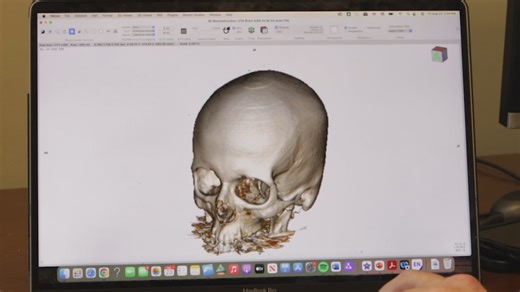 Health Spotlight: Clipping aneurysms through your eyelid