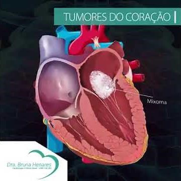 Tumores do Coração