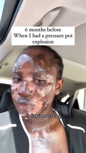 10K views · 40 reactions | The way my skin has transformed in 6...