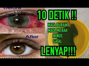 Cara Cepat Menghilangkan Mata Buram, Rabun, Minus ,Merah Dan Mata Gatal Dalam Hitungan Detik!!