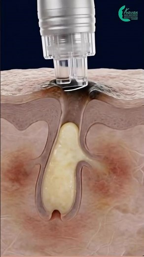 HydraFacial Process Explained in 30 Sec |Step-by-Step |Vacuum Suction, Oxygen Infusion & LED Therapy