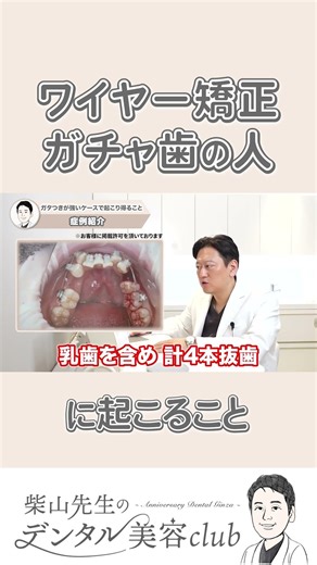 What happens to people with crooked teeth when wearing wire braces #orthodontics #wirebraces #cro...