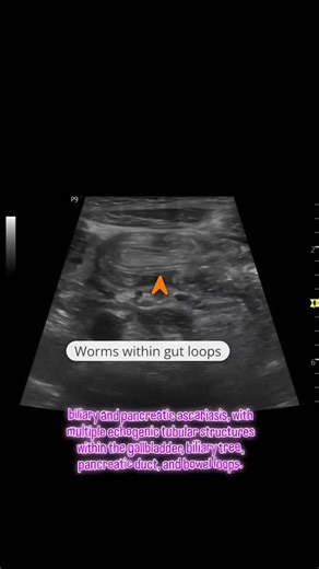 Radiology @all abnormalities 🥏🥏 on Instagram: "Patient Data: Age: 10 years Gender: Male Clinical Presentation: Acute onset abdominal pain and vomiting with passage of worms from the mouth. 🔎 Ultrasound Findings: Grey-scale ultrasound examination reveals: Multiple linear and curvilinear echogenic structures within: Gallbladder lumen Common bile duct (CBD) Multiple intrahepatic biliary radicles Pancreatic duct Small bowel loops The echogenic structures are: Non-shadowing Tubular Some demonstrat