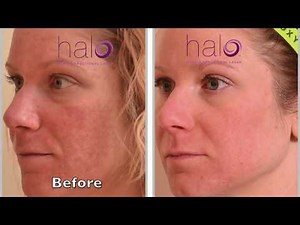 Halo Laser Procedure, Courtesy, Sciton Corporation