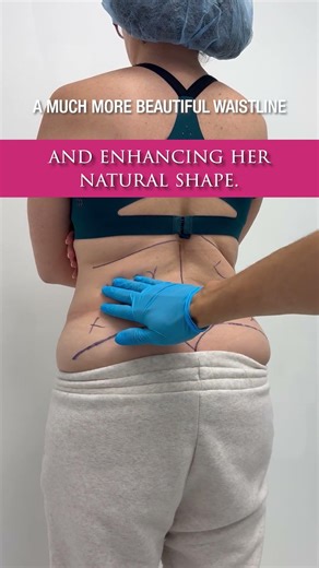 360 lipo isn’t just about removing fat.