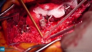 Revision Spinal Fusion T11 Pelvis/L4 PSO: Preparation for PSO in Revision Field