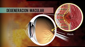64K views · 44 reactions | La degeneración macular asociada a la edad es una enfermedad degenerativa de la mácula que provoca una disminución progresiva de la visión central. ¿Qué produce la degeneración macular? A continuación conversamos con la Dra. Monica González – Oftalmóloga – Especialista en Retina. Cuando de tu salud se trata escoge a Vivir con Salud, hoy con la periodista Luz Nereida Velez… Somos Tu Nuevo Estilo de Vida | Vivir con Salud | Facebook
