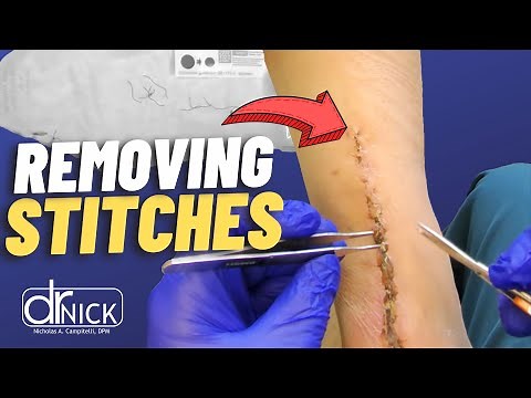 Does Getting Stitches Out Hurt?