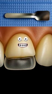 Spoon Anterior Matrix 🏆 #dentistry #dentalphotography #dentaltips | Dental Art