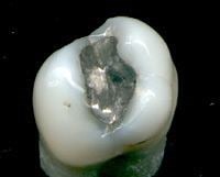 Dental amalgam controversy - Alchetron, the free social encyclopedia