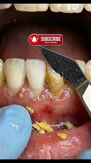 Extreme Calculus Removal ASMR 🦷 #satisfying #shorts