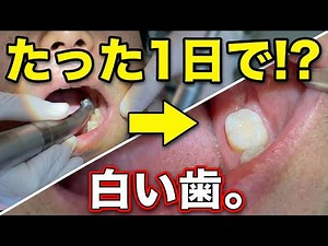 Dentures until implants! Consult your dentist!