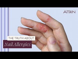 The Truth Behind Nail Allergies | Causes, Symptoms, and Best Solutions