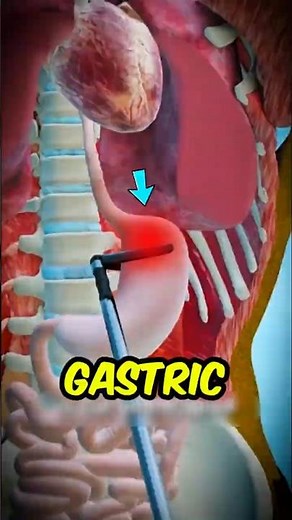 Gastric Bypass: How It Actually Shrinks Your Stomach