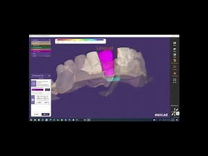 Switching Exocad Implant Scanbody after scanning