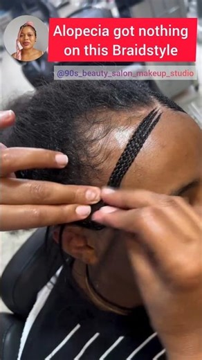 Braid artistry, even without hair you can get this cute braidstyle - Alopecia braids