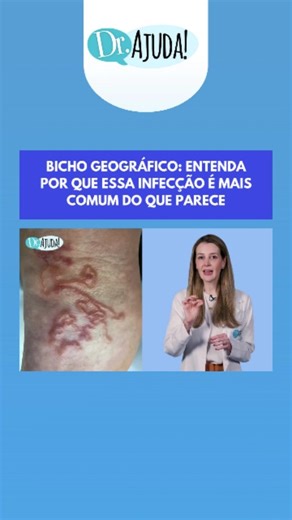 O bicho geográfico, ou larva migrans cutânea, é uma infecção de pele causada por larvas de parasitas presentes nas fezes de cães e gatos, muito comum em países tropicais como o Brasil.☀️ Neste vídeo, a Dra. Vivian Loureiro, dermatologista, explica como ocorre o contágio, sintomas característicos, diagnóstico e os tratamentos mais eficazes. Ela também destaca as principais medidas de prevenção, como o cuidado com áreas de areia e o controle de parasitas em animais domésticos. 🩺 #doutorajuda #der