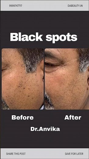 Say Goodbye to Black Spots || Skin Treatment Revealed || bye Dr. Anvika