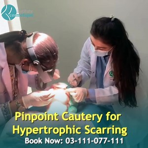 Electrocauterization (or electrocautery) is often used in surgery to remove unwanted or harmful tissue. It can also be used to burn and seal blood vessels. This helps reduce or stop bleeding during surgery or after an injury. It is a safe procedure. Pinpoint Cautery in dermatology cautery is a type of electrosurgery in which a skin lesion is scraped off and heat is applied to the skin surface. Following are some other usages Cautery 1.Removal of Skin Tags 2.Treating Small Angiomas 3.Treatment of