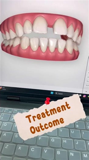 Invisalign Treatment Planning Explained | Digital Smile Correction & Gap Closure #invisalign #trend