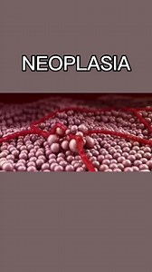 Neoplasia: Causas, Sintomas e Tratamentos