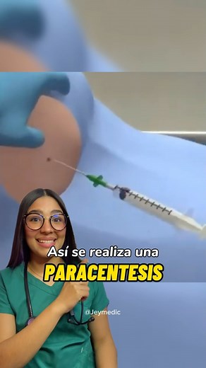 Jeymar Castillo on Instagram: "Así se realiza una paracentesis🫰🏼 Recordemos que existen dos tipo: Paracentesis diagnóstica y terapéutica. En la paracentesis diagnóstica; se extraen muestras de líquido de la cavidad abdominal para ser analizadas y obtener información sobre la causa de la ascitis (Inflamación abdominal causada por la acumulación de líquido) En la paracentesis terapéutica; el objetivo es drenar una gran cantidad del líquido acumulado en la cavidad abdominal, que está comprometien