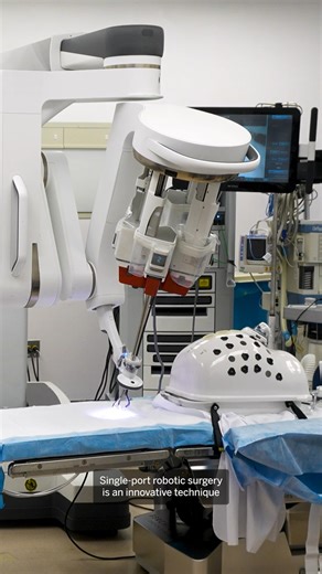 Robotic surgery has transformed minimally invasive procedures, helping patients recover faster and with less pain. Now, the technique is entering a new era with single-port robotic surgery. Rather than making several incisions, surgeons can perform complex procedures through just one small opening. At NYU Langone Health, single-port robotic surgery is already being used in urologic, thoracic, and colorectal surgeries, as well as procedures for living kidney donors. At NYU Langone Hospital—Long I
